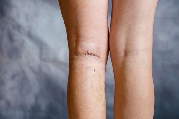 ραφή στο πόδι μετά από χειρουργική επέμβαση για κιρσούς