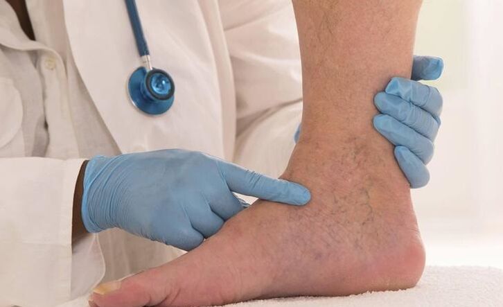 ο γιατρός εξετάζει το πόδι με κιρσούς