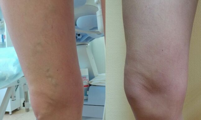 πόδι πριν και μετά τη θεραπεία των δικτυωτών κιρσών